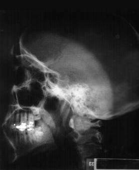 side skull